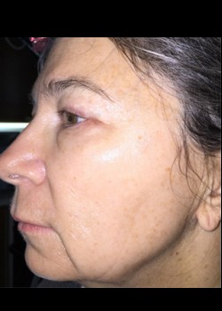 Laser Wrinkle Reduction Patient 2