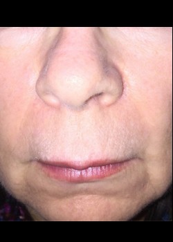 Laser Wrinkle Reduction Patient 3