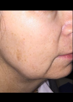Laser Wrinkle Reduction Patient 4