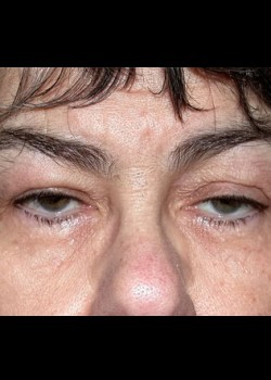 Droopy Eyelid (Ptosis) Patient 3