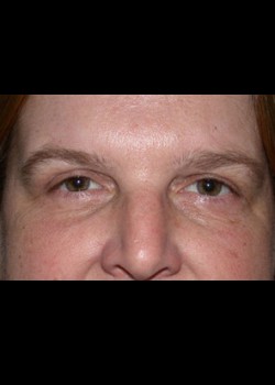 Eyelid Lift – Upper Patient 2
