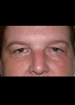 Eyelid Lift – Upper Patient 2
