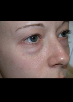 Eyelid Lift – Lower Patient 2