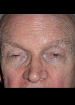 Droopy Eyelid (Ptosis) Patient 1
