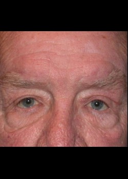 Droopy Eyelid (Ptosis) Patient 2