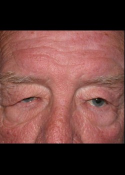 Droopy Eyelid (Ptosis) Patient 2